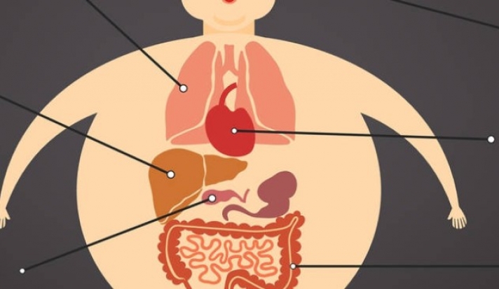 Παχυσαρκία: Για ποιους καρκίνους αυξάνει τον κίνδυνο
