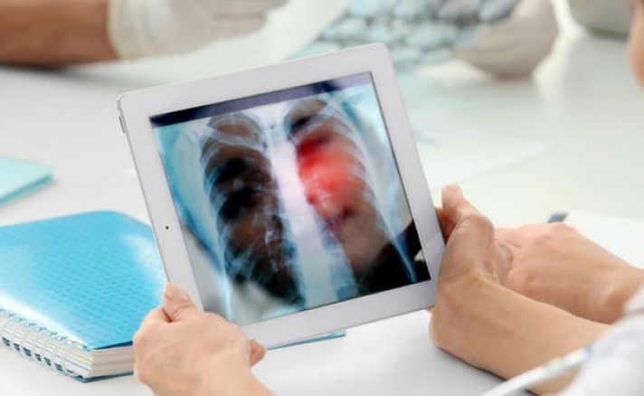 Καρκίνος του πνεύμονα: Το σύμπτωμα που δεν πρέπει να αγνοήσετε